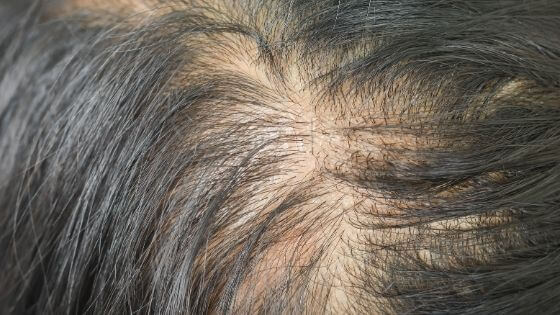 síntomas de la caída del cabello
